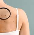 Dia de combate ao câncer: cuidado com novas pintas pelo corpo! -  Foto: Shutterstock / Saúde em Dia