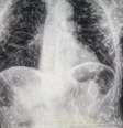 Radiografia de uma pessoa com cisticercose  Foto: Reprodução/ Twitter @vitorborin_