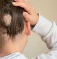 A alopecia é uma doença que afeta tanto homens quanto mulheres -  Foto: Shutterstock / Alto Astral