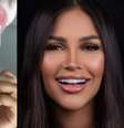 Chip da beleza: há algum benefício? Veja os efeitos colaterais -  Foto: Reprodução Instagram (@flay) / Saúde em Dia