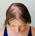 A alopecia pode afetar tanto homens quanto mulheres e conhecer seus sinais é importante -  Foto: Shutterstock / Alto Astral