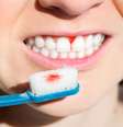 Gengiva sangrando após escovação é normal? Dentista responde -  Foto: Shutterstock / Saúde em Dia
