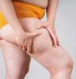 Não é obesidade, é lipedema: saiba como combater o acúmulo de gordura -  Foto: Shutterstock / Saúde em Dia