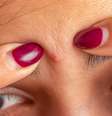 Acne pode ser porta de entrada para bactérias? Entenda -  Foto: Shutterstock / Saúde em Dia