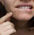 Vitamina B12 pode agravar acne; saiba quais alimentos têm o nutriente -  Foto: Shutterstock / Saúde em Dia