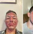 Descubra se o peeling de fenol é seguro |  Foto: Tik Tok @joaoocastros/Reprodução / Boa Forma