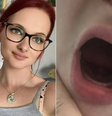Jovem usa dentadura após perder todos os dentes por conta de doença rara na gravidez.   Foto: Reprodução / Daily Mail