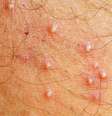 A foliculite é uma doença que atinge a raiz dos pelos da pele -  Foto: Shutterstock / Alto Astral
