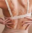 O vitiligo não tem cura, mas tem tratamento -  Foto: Shutterstock / Alto Astral