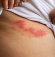 Saiba mitos e verdades sobre o herpes zóster -  Foto: Shutterstock / Alto Astral