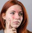 A rosácea não tem cura, mas possui tratamento -  Foto: Shutterstock / Alto Astral