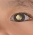 Retinoblastoma: doença não tem prevenção, mas tem cura; entenda -  Foto: Shutterstock / Saúde em Dia