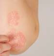 Entenda mais sobre a psoríase - Shutterstock  Foto: Alto Astral