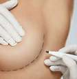 A redução de mamas devolve a qualidade de vida à mulher -  Foto: Shutterstock / Alto Astral