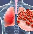Pneumonia: conheça as opções de vacinas contra a doença -  Foto: Shutterstock / Saúde em Dia