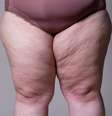 Lipedema: entenda como é a cirurgia para tratar a condição -  Foto: Shutterstock / Saúde em Dia