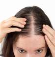 Alopecia areata é diferente da alopecia androgenética, a calvície que herdamos de família.   Foto: Cunaplus_M.Faba