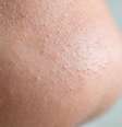 Veja como evitar poros dilatados -Shutterstock  Foto: Alto Astral