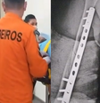 O adolescente foi socorrido pelo Corpo de Bombeiros e precisou colocar um pino no braço  Foto: Reprodução/Instagram/@moabbrasil