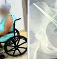 Mulher ficou 3 meses com pinça esquecida em região pélvica.  Foto: Reprodução/GloboPlay/TV Tem