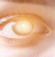 Fotofobia: olhos ficam mais sensíveis nesta época do ano -  Foto: Shutterstock / Saúde em Dia
