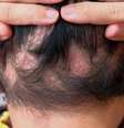 A alopecia areata é uma doença que provoca a queda severa de cabelo -  Foto: Shutterstock / Alto Astral