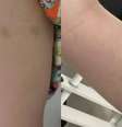 Hematomas –  Foto: Reprodução/ Balanço Geral / Famosos e Celebridades