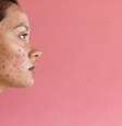O verão está chegando! Saiba como cuidar da acne na estação -  Foto: Shutterstock / Saúde em Dia