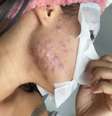 No começo do ano, a cantora e compositora Flay mostrou em suas redes sociais os efeitos do chip da beleza em sua pele. Ela disse que não foi informada sobre os efeitos colaterais do implante pelo seu médico.  Foto: Reprodução/ Instagram: @flay / Estadão