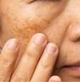 Melasma: sol do verão pode causar manchas escuras na pele  Foto: Shutterstock / Saúde em Dia