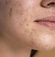 A acne é causada pelo bloqueio ou inflamação dos folículos pilosebáceos (Imagem: Freepik/Domínio Público)  Foto: Canaltech