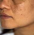 Melasma e sol: saiba como amenizar as manchas no verão  Foto: Shutterstock / Saúde em Dia