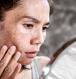 Manchas e verão como não piorar o seu melasma na época mais quente do ano  Foto: Sou Mais Bem Estar