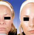 Gêmea que não aplicou botox (à esquerda) versus gêmea que aplicou (à direita)  Foto: Dermatologic Surgery