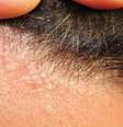 Dermatites de verão: os sintomas e como tratar cada quadro  Foto: Shutterstock / Saúde em Dia