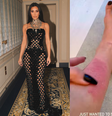 Kim compartilhou imagens de sua psoríase com os seguidores  Foto: @kimkardashian