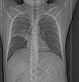 Exames de raio-x, tomografia e biópsia são utilizados para diagnosticar a doença  Foto: Reprodução / BBC News Brasil