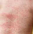 O aparecimento de manchas vermelhas na pele é um sintoma associado à febre hemorrágica da dengue  Foto: Getty Images / BBC News Brasil