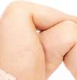 Lipedema ou celulite? Especialista explica as diferenças entre as condições  Foto: Shutterstock / Saúde em Dia