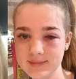 Amelia Gregory, da Inglaterra, quase ficou cega após seguir as dicas de uma influenciadora no TikTok   Foto: Instagram / Reprodução