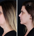 Lipo de papada o que é e quais as indicações  Foto: Sou Mais Bem Estar