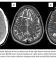 Apiaxonado por bacon, paciente descobre que tem larvas de tênia no cérebro por causa de fortes dores de cabeças (Imagem: Byrnes et al., 2024/American Journal of Case Reports)  Foto: Canaltech