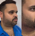 Michel, do BBB24, faz lipo de papada  Foto: 
