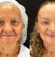 Antes e depois do tratamendo de Peeling de Fenol em Maria Ivone  Foto: Divulgação/Lucas Miranda