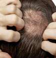 Calvície precoce: vejas as causas de perda de cabelo entre os jovens  Foto: Shutterstock / Saúde em Dia