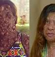 Charmaine Sahadeo antes e depois da cirurgia para retirada dos tumores  Foto: @charmaine__sahadeo