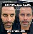 Henri Castelli realiza harmonização facial; confira o resultado  Foto: @avallonecamila / @avallonecamila