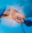 Miopia, hipermetropia e astigmatismo: cirurgia refrativa pode corrigir visão  Foto: Shutterstock / Saúde em Dia