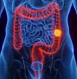 Aumento proporcional de casos de tumor no intestino entre mais jovens chamou a atenção de cientistas  Foto: Getty Images / BBC News Brasil