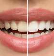 Clareamento dental deve ser feito por dentista  Foto: New Africa | Shutterstock / Portal EdiCase